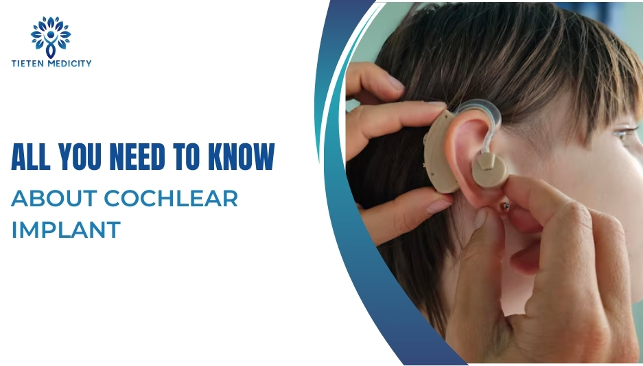 All You Need To Know About Cochlear Implant