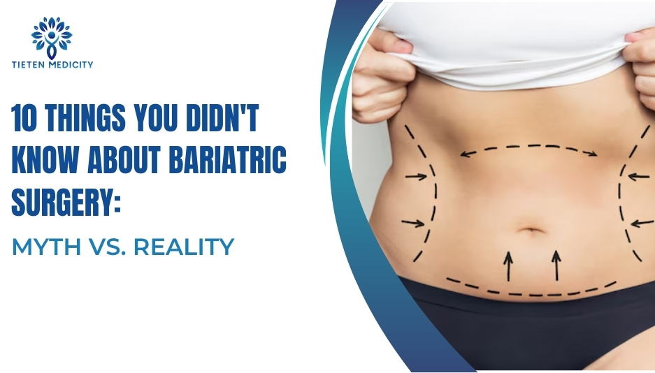 10 Things You Didn’t Know about Bariatric Surgery: Myth vs. Reality