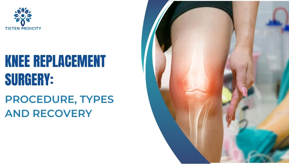 Knee Replacement Surgery: Procedure, Types and Recovery